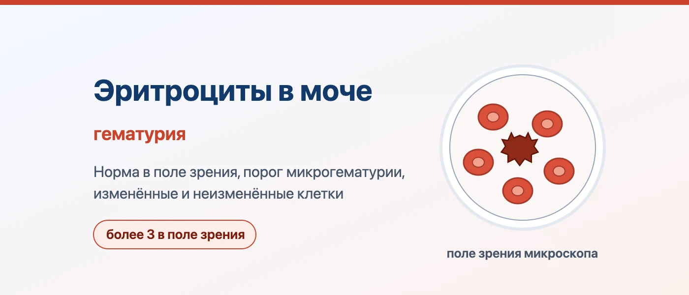 Обложка статьи: Эритроциты в моче: норма в поле зрения и причины гематурии