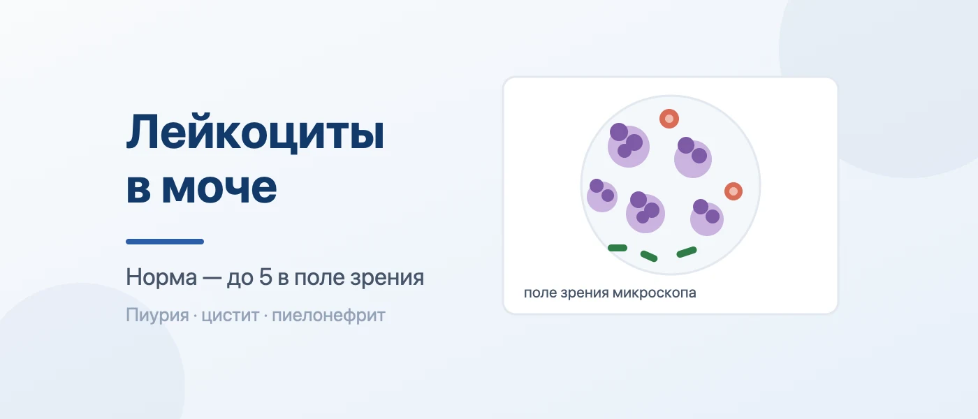 Обложка статьи: Лейкоциты в моче: норма в поле зрения, причины повышения